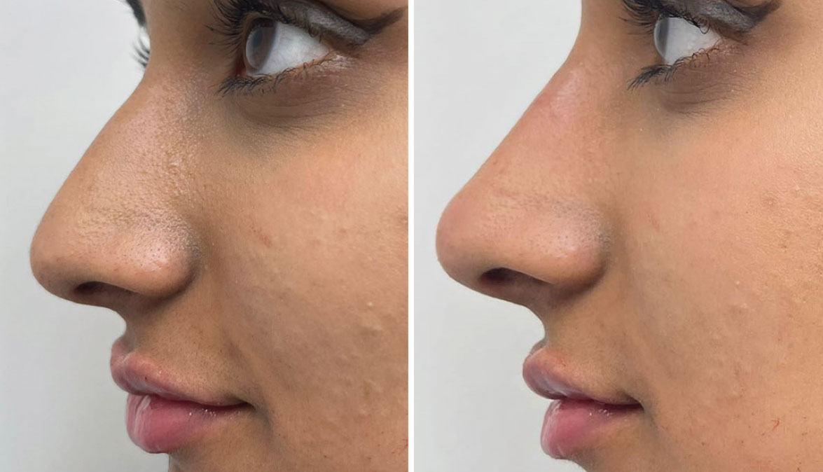 Non surgical rhinoplasty (Before & After)
