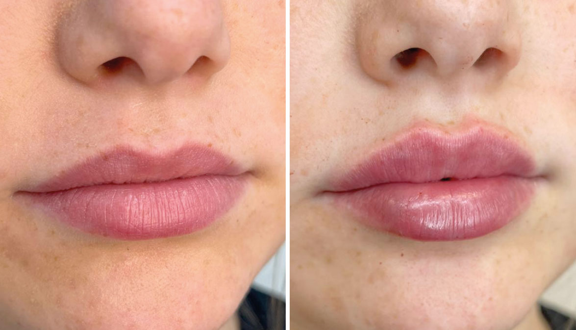 Lip dermal filler (Before & After)